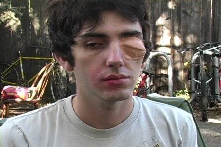 A man with a severely swollen left eye.