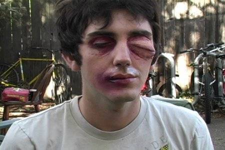 A man sits outside in a playground area with a grotesquely swollen left eye.