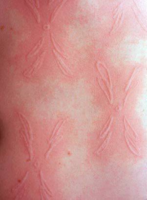 Welts are forming letters on a person's skin.